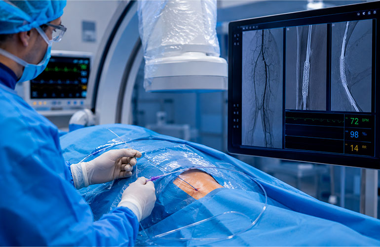 Terapia endovascular